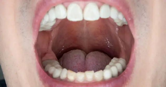 Widoczne białe zęby i zaczerwienione podniebienie, gdzie może być ropień. Język jest lekko widoczny.