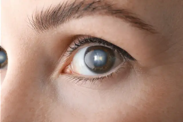 Objawy zaćmy u seniora: Jak je rozpoznać i uniknąć pogorszenia wzroku