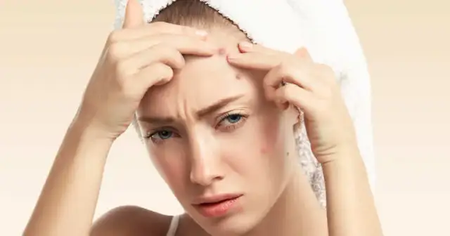 Jak szybko pozbyć się pryszcza i uniknąć blizn na skórze