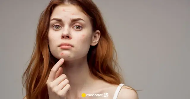 Jak zlikwidować pryszcze? Ekspert radzi: Szybko i skutecznie!