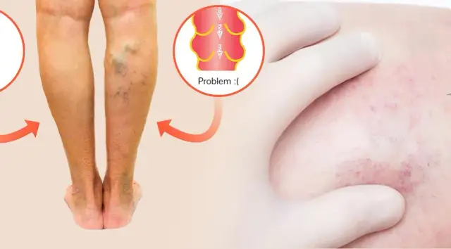 Zakrzepica łydki objawy – jak je rozpoznać i uniknąć powikłań