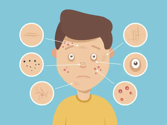 Trądzik młodzieńczy: Skuteczne porady na pryszcze. Co stosować?