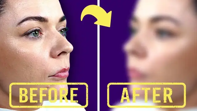 Jak długo utrzymuje się efekt powiększania ust kwasem hialuronowym?