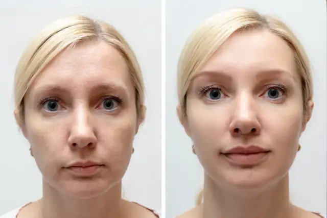 Przed i po zabiegu: skóra kobiety przed jest szorstka i pomarszczona, po jest gładka i promienna. Widać, jak osocze jak wygląda, odmładzając cerę.