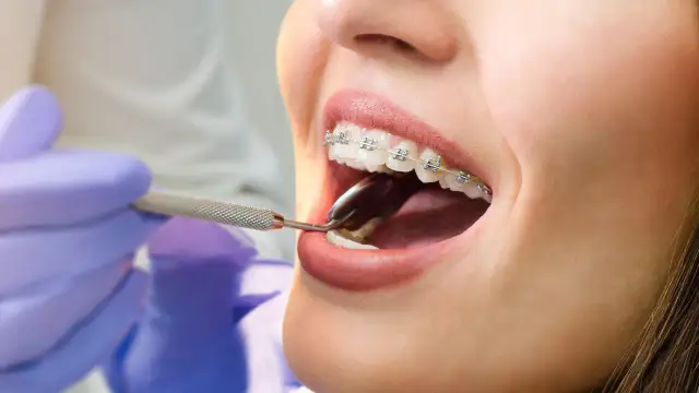 Alkohol a aparat ortodontyczny: Jak pić bez szkody dla zębów?