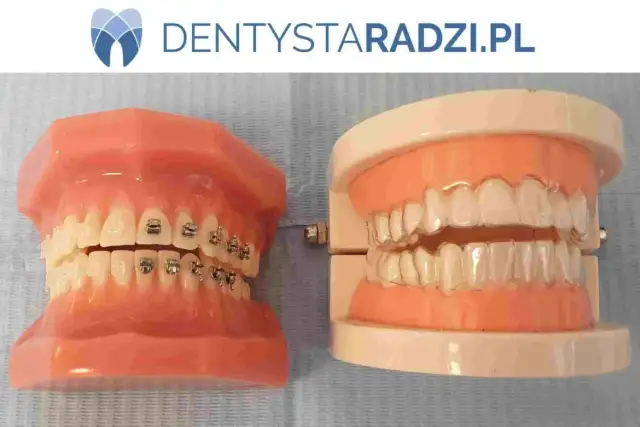 Ile nosi się aparat stały? Od czego zależy czas leczenia?
