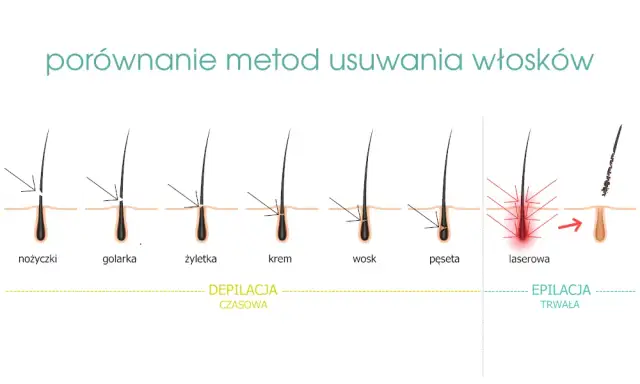 Elektroepilacja: Jedyna trwała depilacja dla każdego włosa?