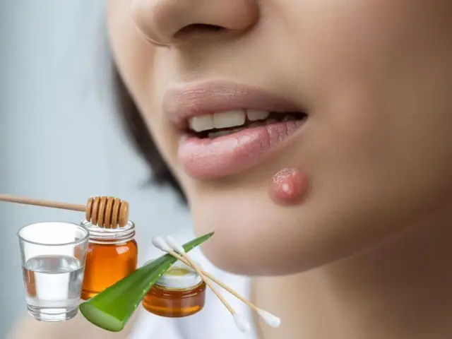 Bolesne afty? Szybka ulga! Leki z apteki i domowe sposoby.