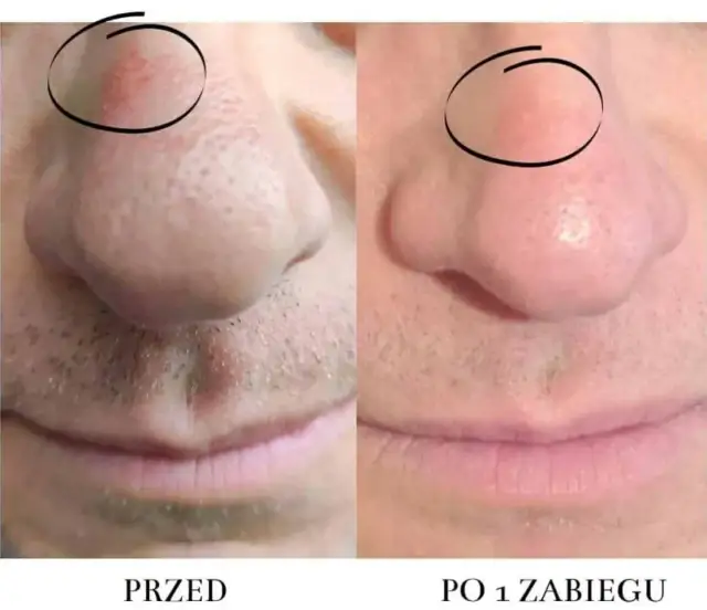 Cera naczynkowa: Jak się pozbyć rumienia i wzmocnić naczynka?