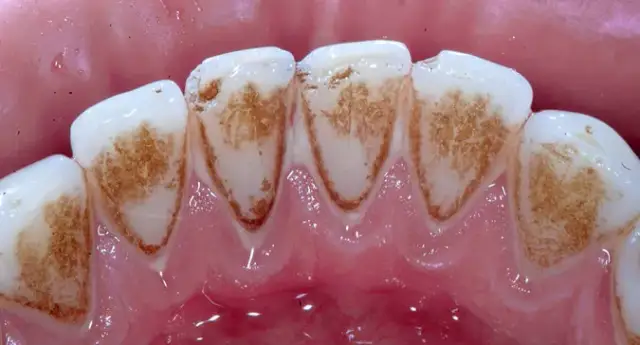 Usuwanie osadu nazębnego w domu? Co działa, a co szkodzi zębom.