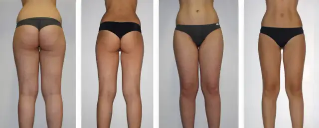 Endermologia: Czy warto? Analiza kosztów, efektów i opinii eksperta