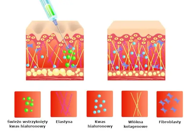 Jak nakładać kwas hialuronowy, aby uniknąć najczęstszych błędów