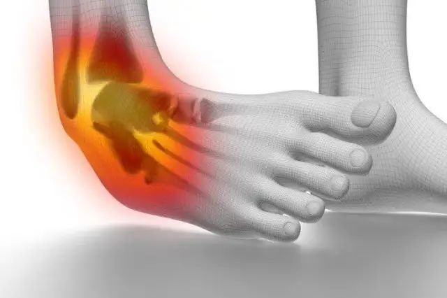 Ile trwa L4 po skręceniu kostki? Stopnie urazu, praca, rehabilitacja.