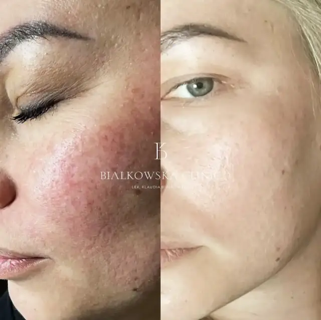 Laser frakcyjny a alkohol: Kiedy możesz pić bezpiecznie?