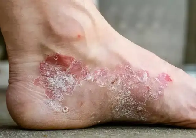 Jak efektywnie leczyć łuszczycę na stopach? Porady