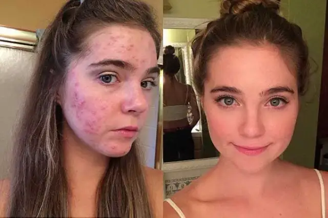 Jak pozbyć się pryszcza, który jeszcze nie wyszedł – skuteczne metody