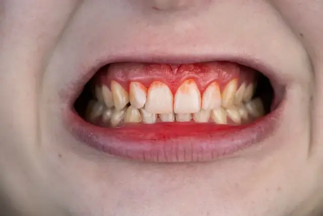 Koniec z krwawieniem! Jak mieć zdrowe dziąsła? Poradnik