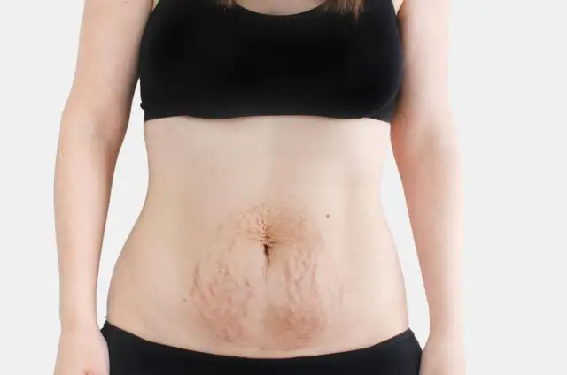Brzuch miesiąc po porodzie, z widocznymi rozstępami. Ciało po ciąży, naturalne zmiany.