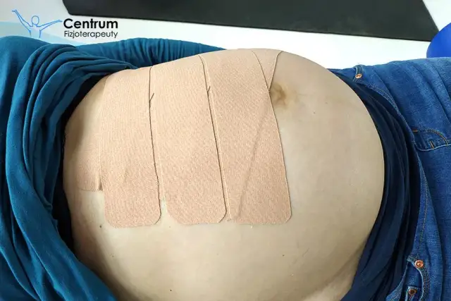 Jakie ćwiczenia przy przepuklinie pępkowej pomogą uniknąć bólu?