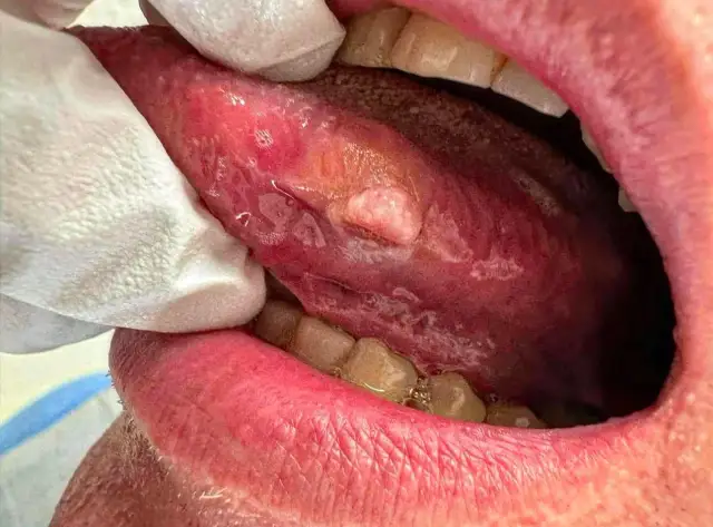 Rak płaskonabłonkowy jamy ustnej: objawy, ryzyko i wczesne wykrycie