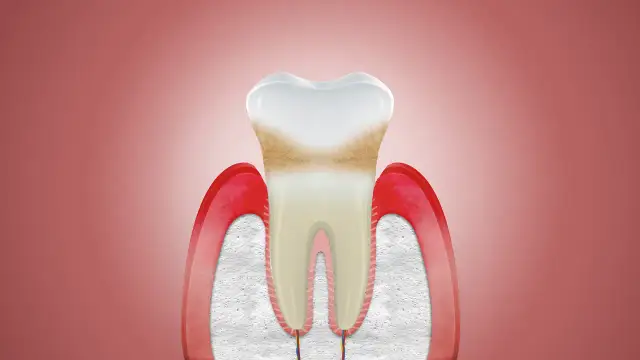 Jak odbudować dziąsła - skuteczne metody regeneracji i leczenia