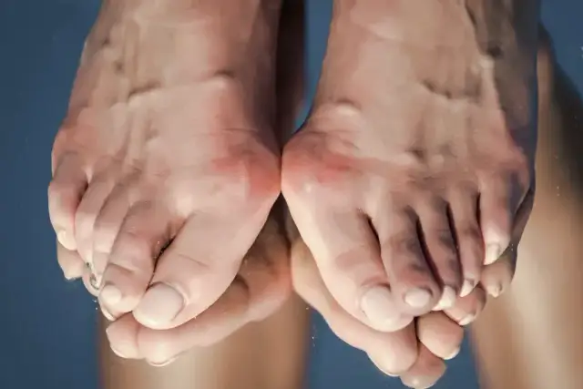 Skuteczne sposoby na ból haluksa, które przynoszą ulgę w domu