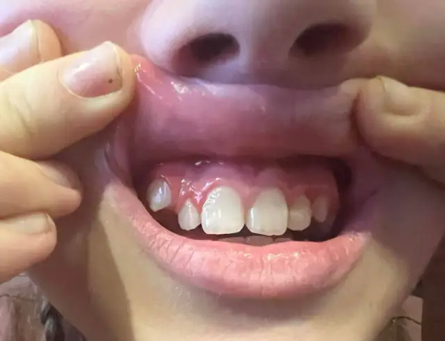 Co zrobić, gdy ząb rośnie na dziąśle? Poradnik eksperta.