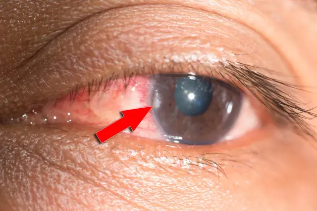 Jak okulista usuwa ciało obce z oka? Procedura krok po kroku