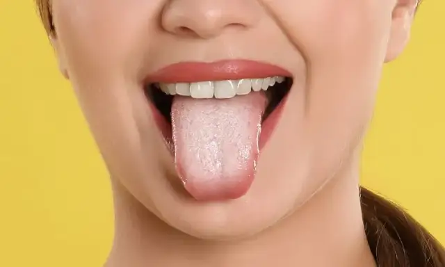 Jak leczyć pęcherze w jamie ustnej? Domowe i apteczne sposoby