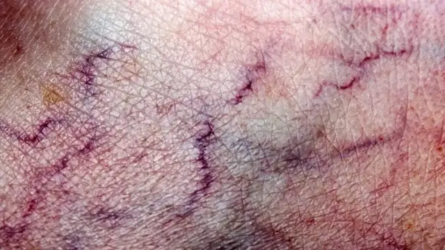 Zakrzepica – jakie badania krwi są kluczowe dla Twojego zdrowia?