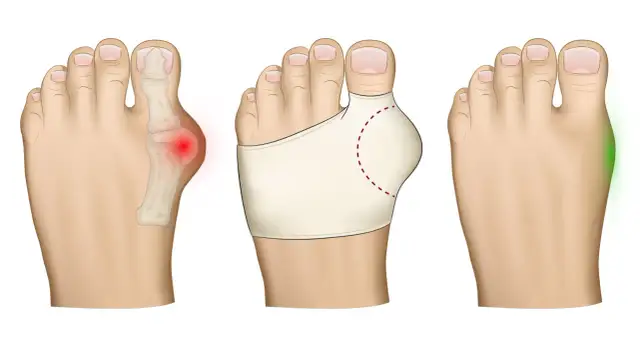 Haluksy bolą? Szybka ulga i skuteczne leczenie poradnik eksperta