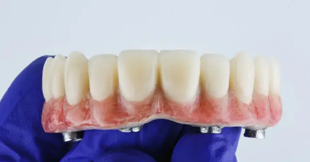 Proteza zębowa NFZ: Co 5 lat nowa? Zasady i warunki refundacji