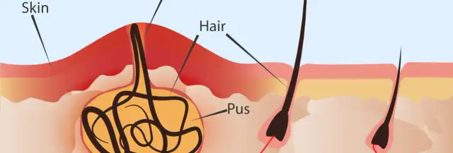 Torbiel włosowa jaki lekarz - Jak uniknąć poważnych komplikacji?