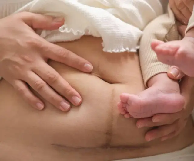 Ból brzucha po cesarce: Co jest normą, a co sygnałem alarmowym?