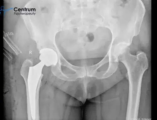 Rehabilitacja po złamaniu kostki bocznej: Ile trwa i co Cię czeka?