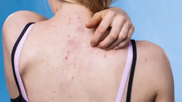 Jak skutecznie pozbyć się pryszczy na plecach i odzyskać pewność siebie