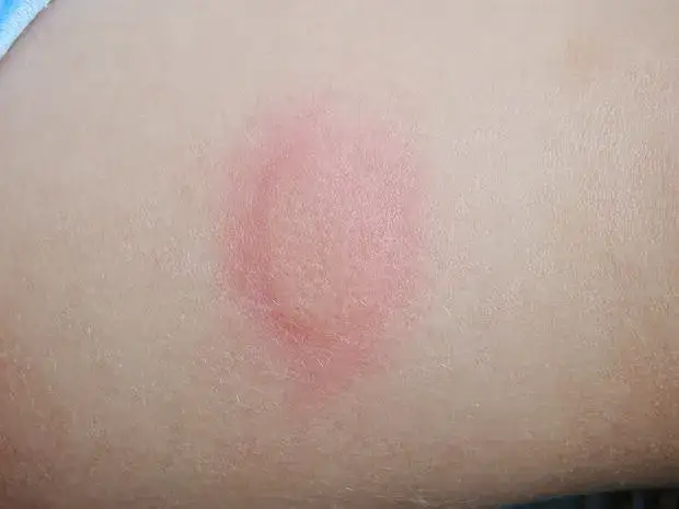 Bolesne gule pod skórą: Szybkie sposoby leczenia i zapobiegania