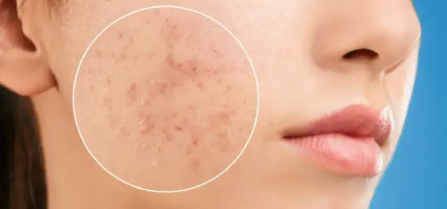 Trądzik u dorosłych? Kompleksowy poradnik: pielęgnacja, dieta, leczenie