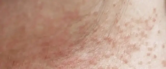 Jak rozpoznać potówki u niemowlaka - objawy i skuteczne leczenie