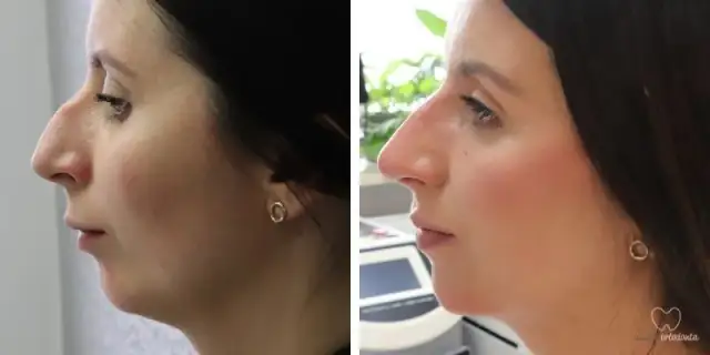 Czy aparat zmieni Twoją twarz? Rysy, profil, broda po leczeniu.