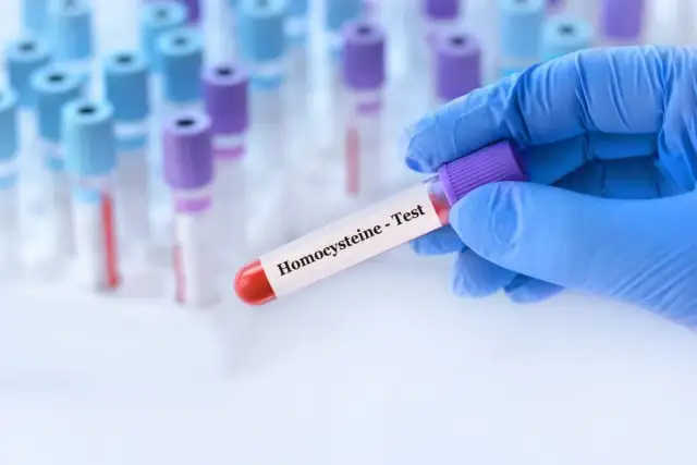 Homocysteina - Co oznacza Twój wynik i kiedy wymaga reakcji?