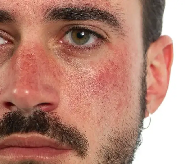 Niechciany zarost na twarzy? Poznaj przyczyny i trwałe rozwiązania
