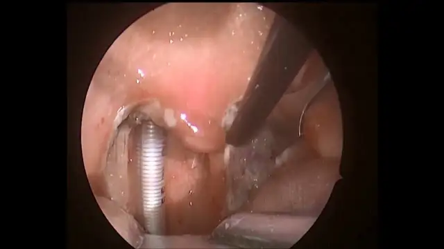 Skutki uboczne wycięcia migdałków: co musisz wiedzieć o ryzykach.