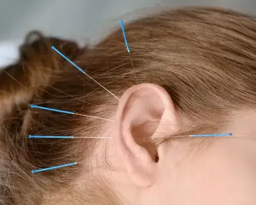 Akupunktura ucha: Jak skutecznie złagodzić ból i stres?