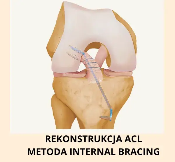 Rekonstrukcja ACL prywatnie czy na NFZ – co wybrać, by uniknąć błędów i kosztów?