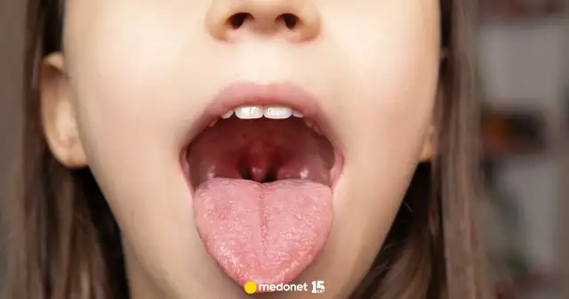 Wirus czy bakteria? Jak rozpoznać ból gardła i kiedy do lekarza?