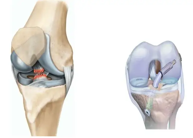 Rekonstrukcja ACL prywatnie czy na NFZ – co wybrać, by uniknąć bólu?