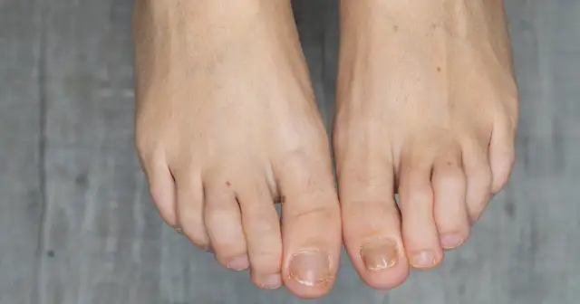 Olejki na grzybicę paznokci: naturalne wsparcie i bezpieczna kuracja