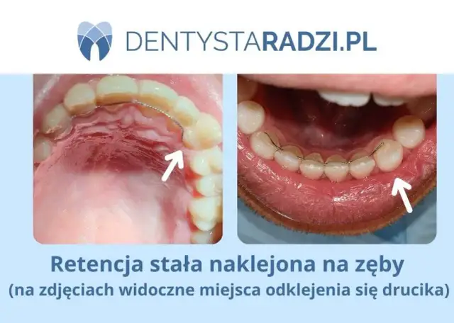 Ile kosztuje nakładka retencyjna? Ceny, opcje i porady eksperta