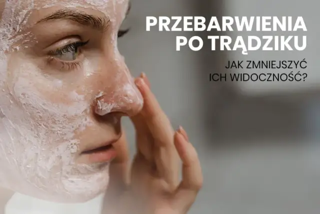 Jak pozbyć się blizn po pryszczach? Domowe i profesjonalne metody